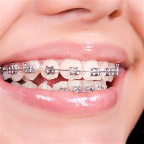 ventajas y desventajas de los brackets metalicos|brackets de metal.